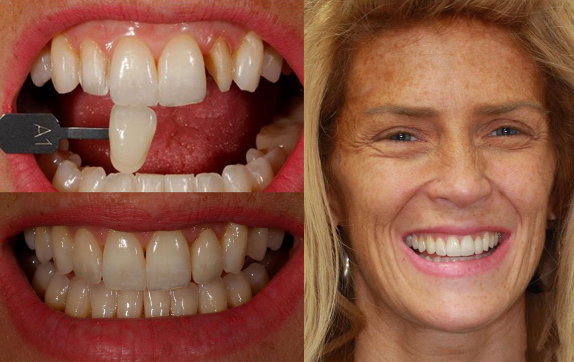 veneer