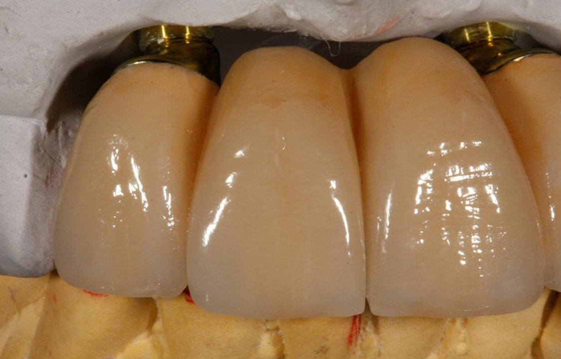 Ti Abutment
