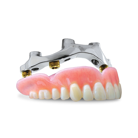 Denture with Overbar
